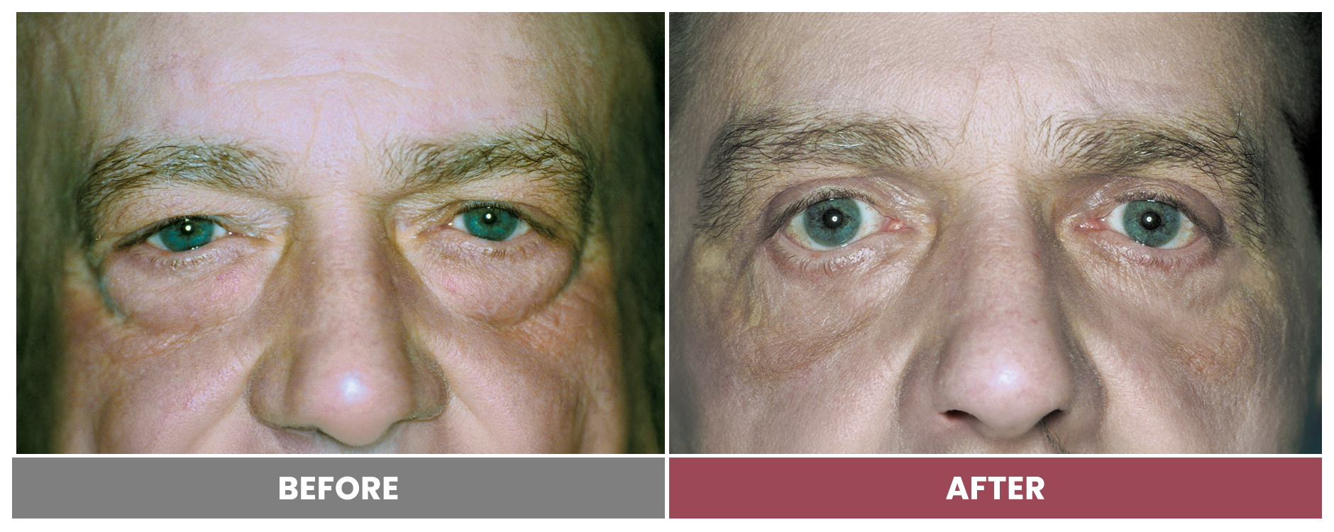 PTOSIS REPAIR - Case 13